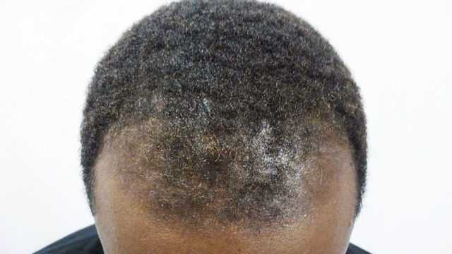 восстановление волос у мужчин