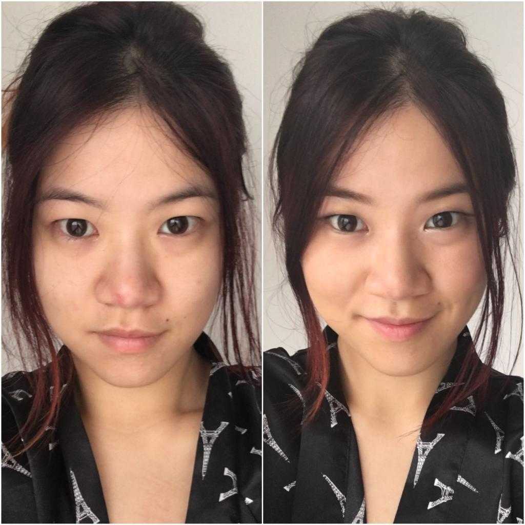 увеличение глаз до и после операции