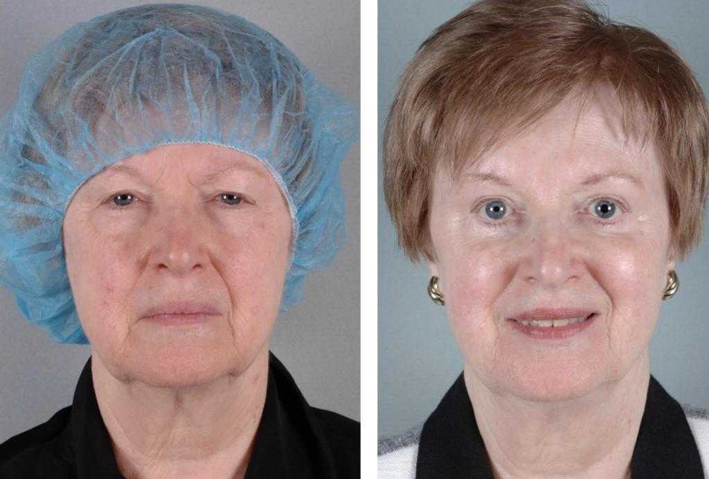 До и после операции на глаза