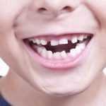 Второй ряд зубов у детей: причины, методы коррекции