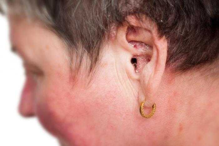 Симптомы рака среднего уха