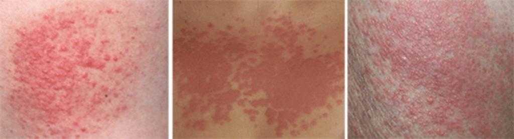 аллергическую реакцию на коже