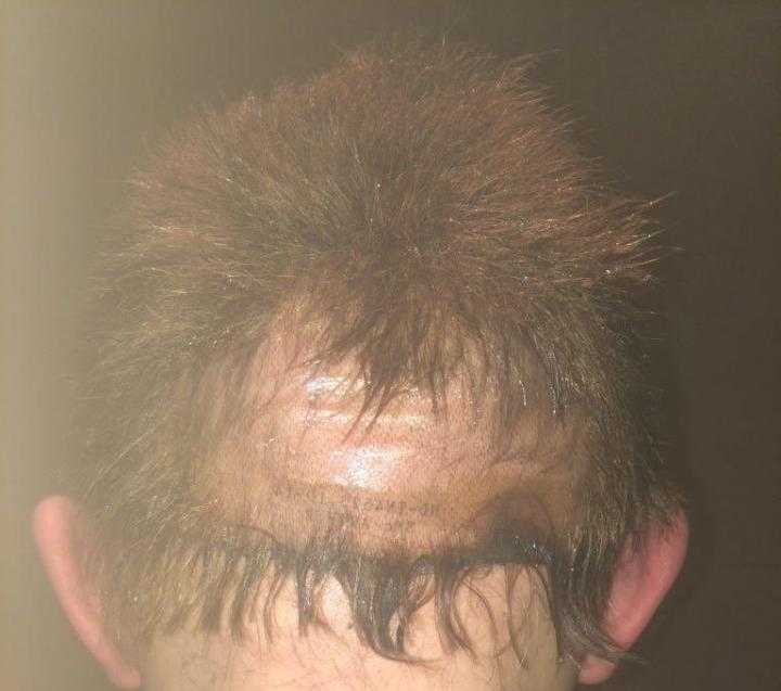 пересадка волос на голове москва