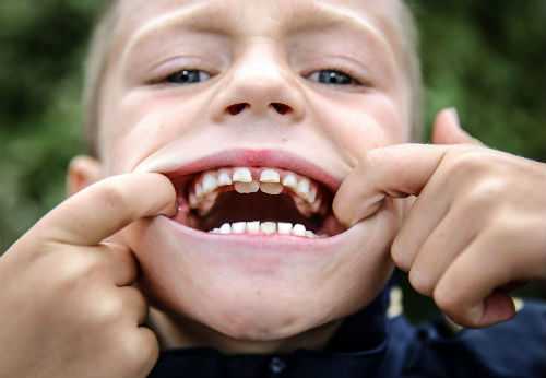 второй ряд зубов у детей