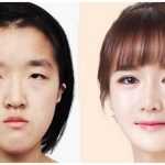 Операция по увеличению глаз: технология проведения, описание, эффект, фото до и после