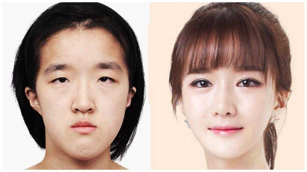 до и после операции по увеличению глаз