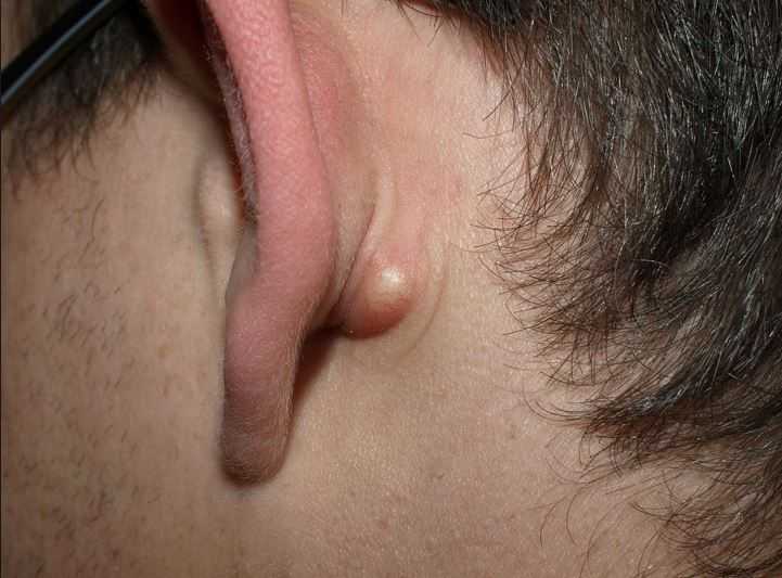 Симптомы рака уха