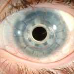 Синдром Фукса в офтальмологии: причины, симптомы, диагностика и лечение