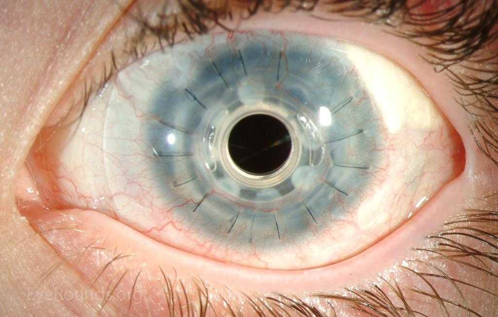 Глаз при синдроме Фукса