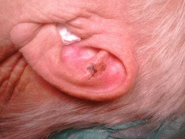 Симптомы и признаки рака уха