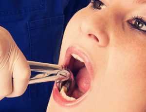 Почему после удаления зуба запах изо рта?