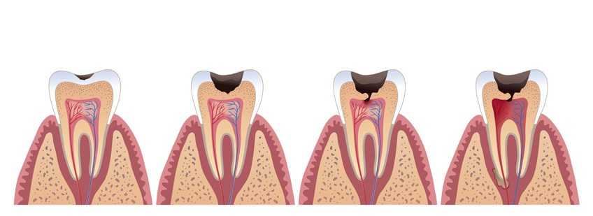 Возникновение кариеса зубов