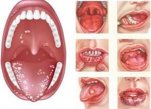 Как выглядит аллергия во рту?