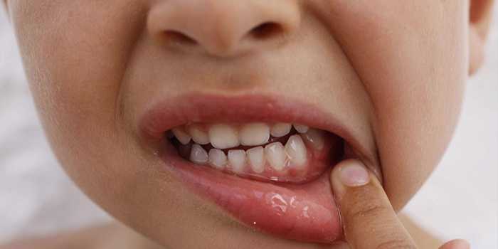 зуб после лечения периодонтита