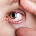 Глазной клещ у человека: первые признаки, симптомы, диагностика и лечение