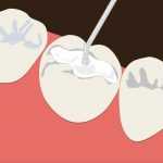 Почему болит зуб под пломбой при надавливании?