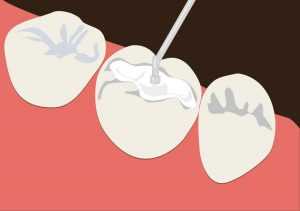 Почему болит зуб под пломбой при надавливании?