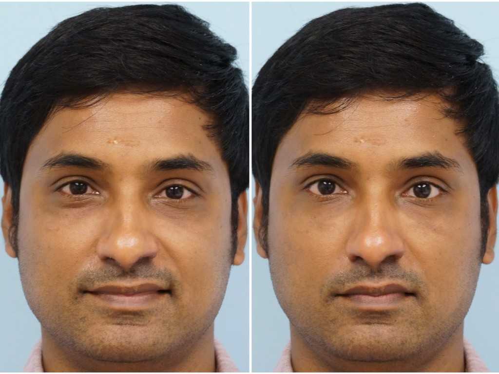 увеличение глаз до и после операции