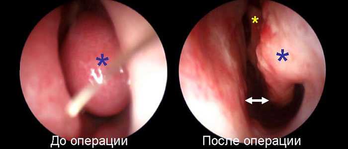Лазерная вазотомия носовых