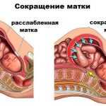 Что такое гипертонус матки: симптомы, диагностика, лечение