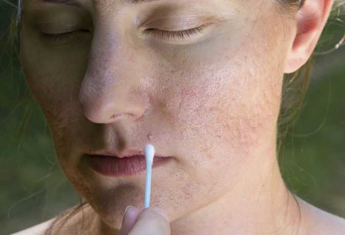 как проявляется аллергия на крем для лица