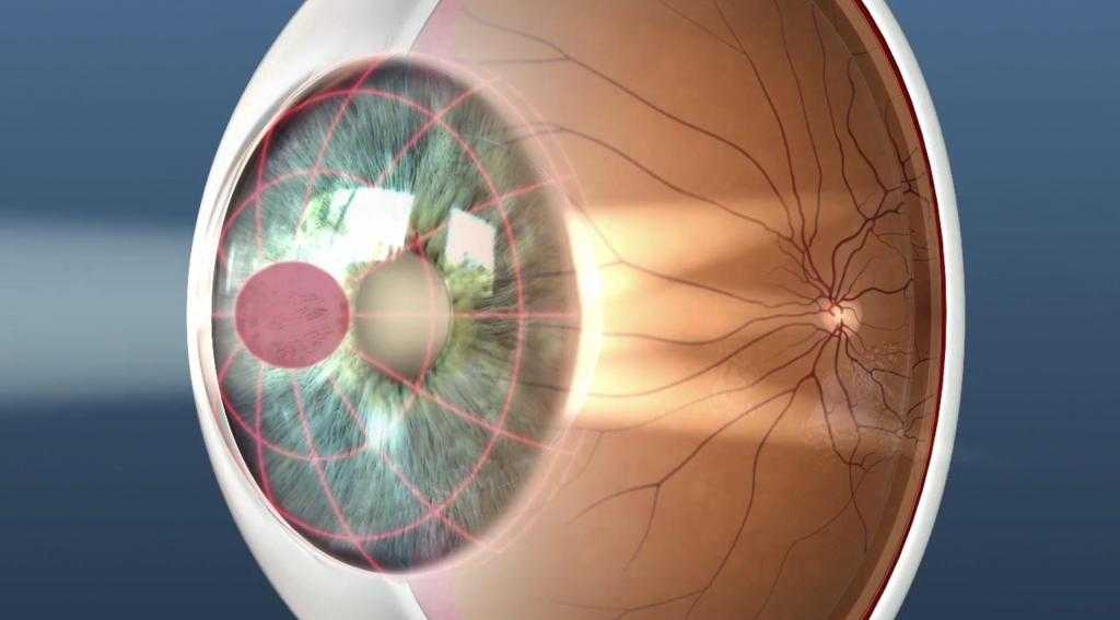 операция на глаза при астигматизме