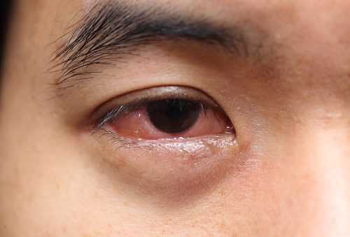 заболевания глаз