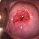 Эритроплакия шейки матки: симптомы, диагностика, методы лечения, отзывы