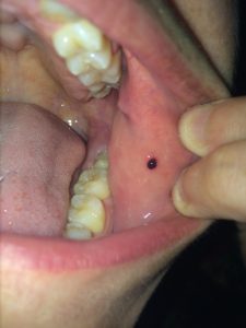 Во рту на щеке черная точка: причины и методы лечения. Ополаскиватели для полости рта. Гель стоматологический противовоспалительный