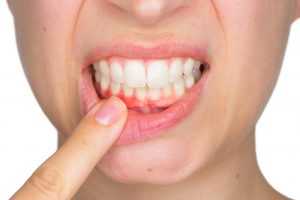 Что такое периодонтит зуба? Лечение периодонтита молочных зубов