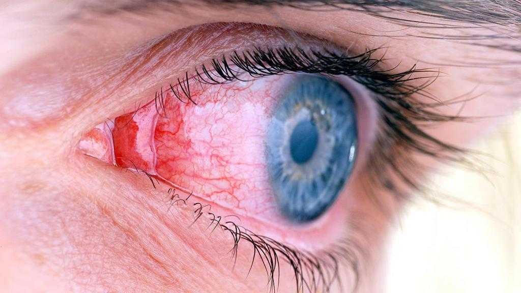 кровоизлияние в сетчатку глаза