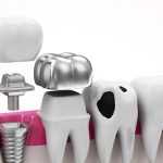 Какая пломба лучше: виды, состав, долговечность и советы стоматологов