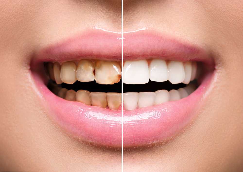 реставрация зубов фото до и после