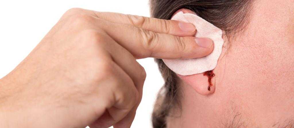 помощь при кровотечении из уха