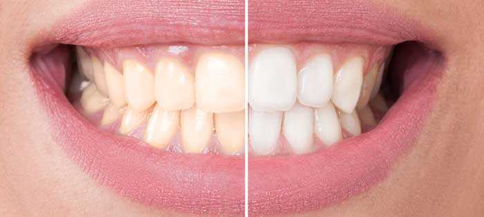 Как делают красивые зубы звездам