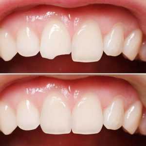 Реставрация передних зубов пломбировочным материалом. Современные технологии эстетической стоматологии