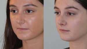 Уменьшение кончика носа: описание процедур, результат, фото и отзывы