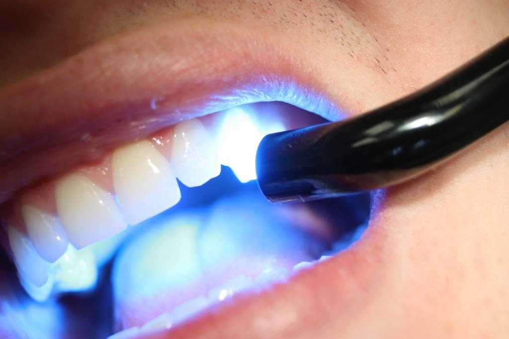 Как делают белоснежные зубы звезды