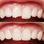 Больно ли ставить пломбу на зуб? Описание этапов, особенности и рекомендации