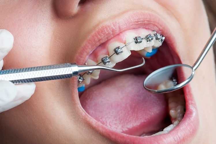 как отреставрировать передние зубы