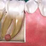 Киста в десне зуба: лечение народными средствами