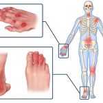 Псориаз суставов: причины, симптомы с фото, диагностика и лечение