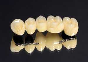 Металлокерамические мосты на зубы