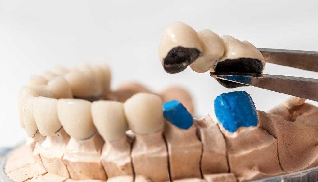 Металлокерамический мост на жевательные зубы