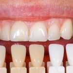 Реставрация зубов - это... Описание процедуры, виды материалов, фото до и после