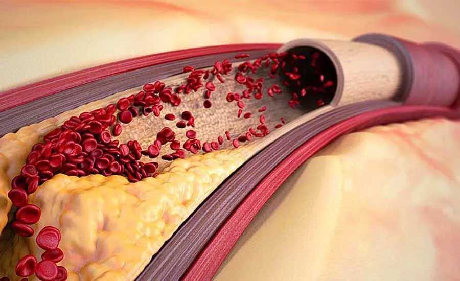 Стеноз бедренной артерии