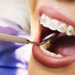 Как снимают брекеты с зубов: описание процедуры. Сколько носить брекеты и что делать после снятия