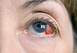 Кровоподтек в глазу: причины и лечение. Сколько проходит кровоподтек в глазу