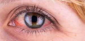 Причина красных глаз у взрослого и методы лечения. Травмирование и заболевания глаз