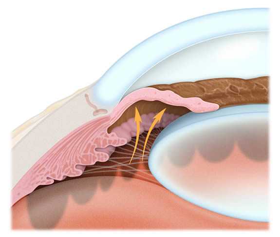 закрытоугольная глаукома причины симптомы